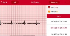 ecg